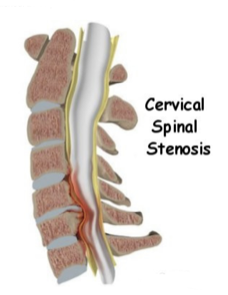 Cervical Spinal Stenosisl